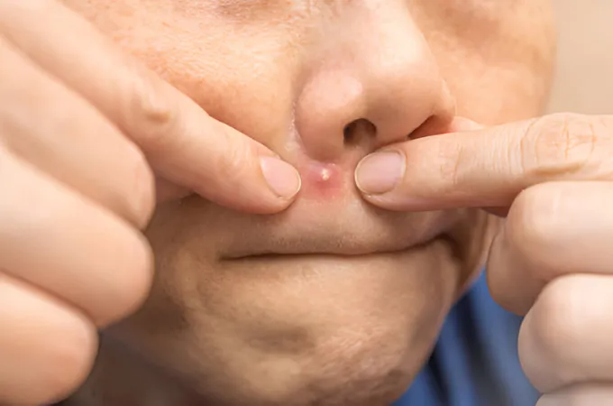 jerawat di bibir