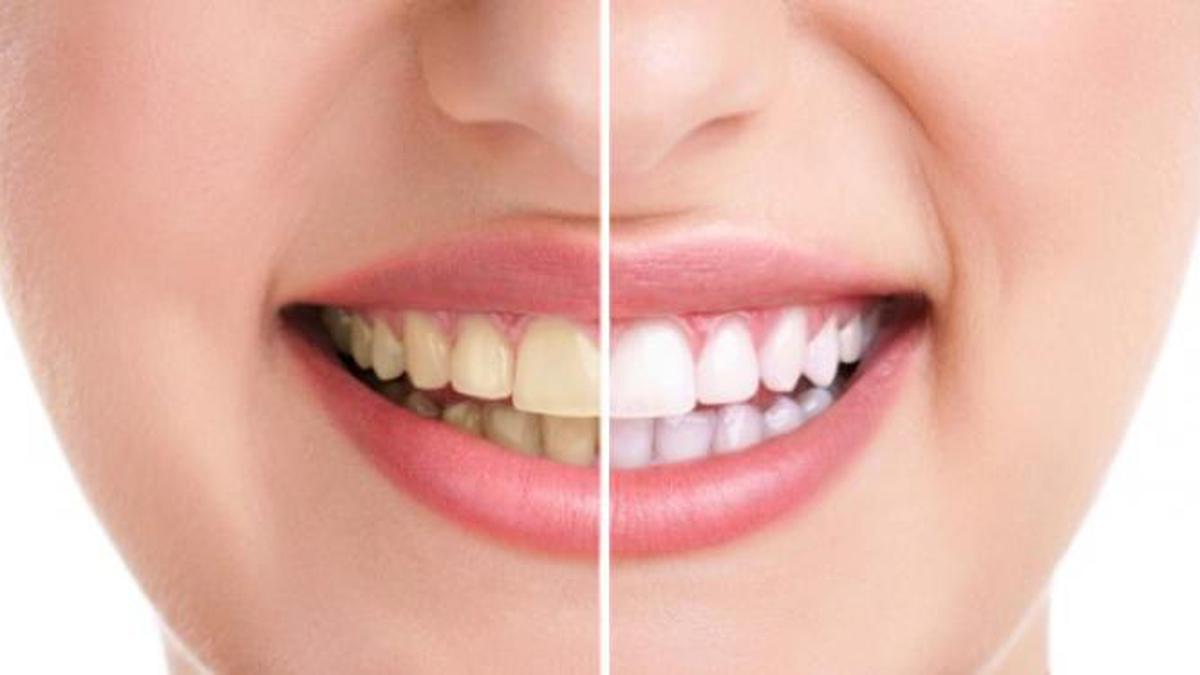Cara Memutihkan Gigi Secara Alami dan Aman