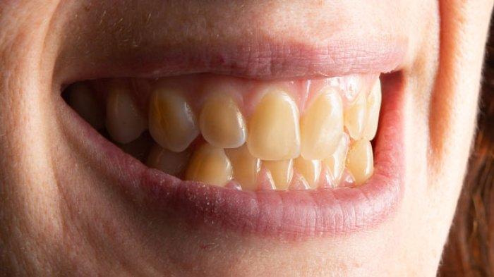Penyebab dan Cara Mengatasinya Gigi Kuning dan Berplak