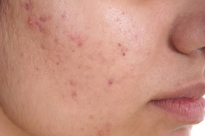 Solusi Kulit Sehat dengan Toner